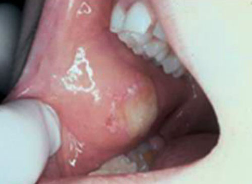 Oral-Cancer-2.jpg