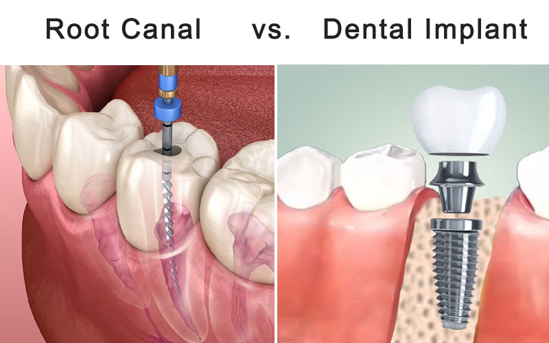Root-Canal-vs-Dental-Implan.jpg
